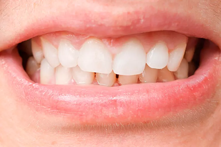 invisalign cuanto cuesta en lima