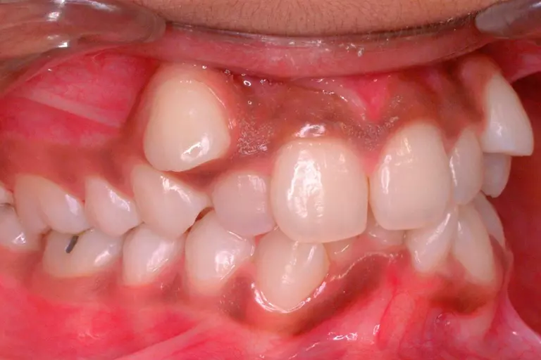 invisalign dientes en lima