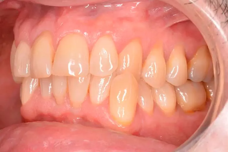 ortodoncia invisalign en jesus maria