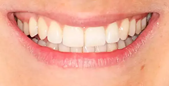 ortodoncia invisalign en san miguel