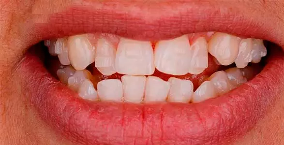 precio del invisalign en jesus maria