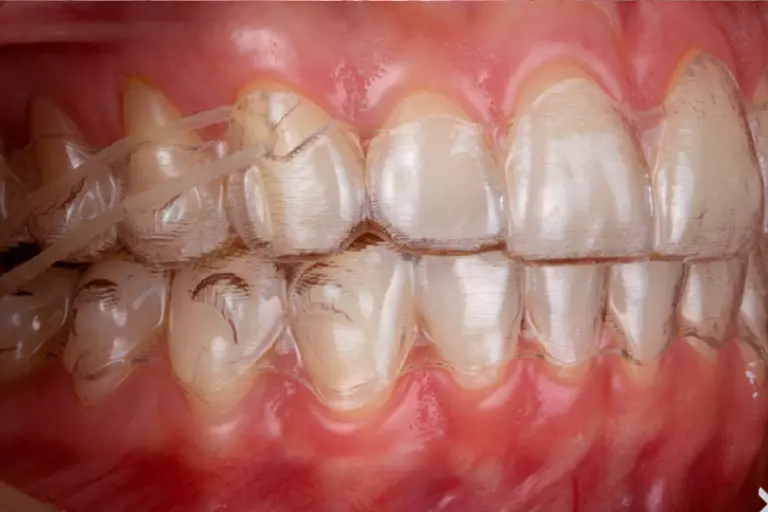 tratamiento invisalign en lima