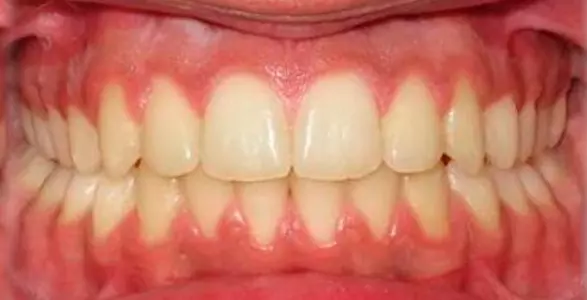 tratamiento invisalign en san miguel